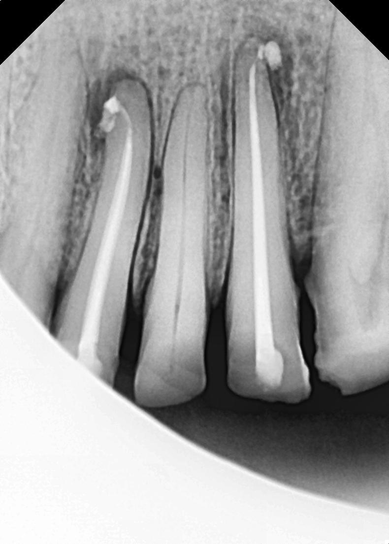 Root Canal Treatments with Precision and Care